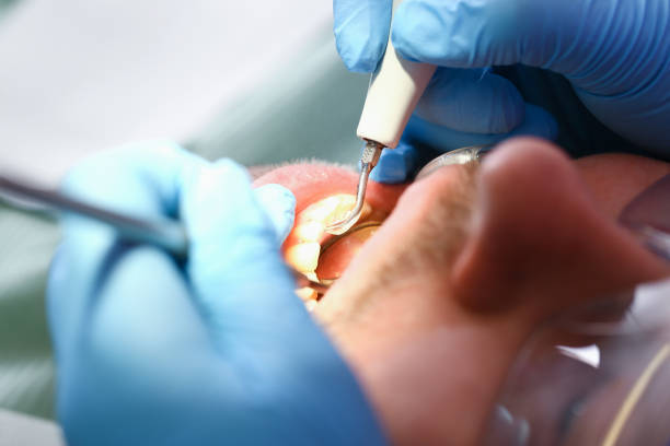 Best Emergency Root Canal Treatment in Early, TX